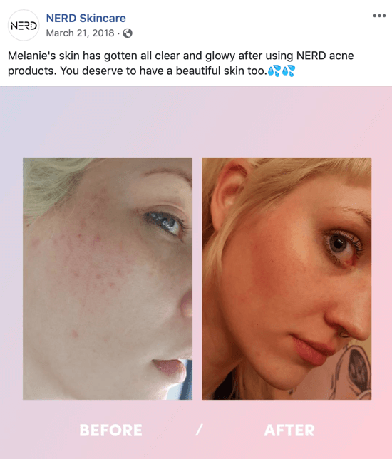 Example of how Nerd Skincare used a before-and-after picture to create an image post for social media that drives purchases of their products.